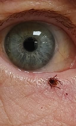 Deer Tick (Black-legged Tick)